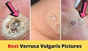Image result for Verruca Vulgaris Intraoral