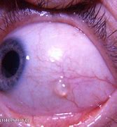 Image result for Bulbar Conjunctival Lymph Cyst