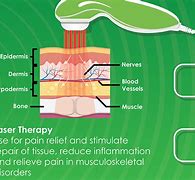 Image result for Cold Laser Therapy
