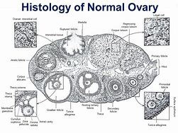 Image result for Hypervascular Ovarian Tumor