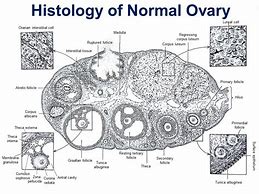 Image result for Chaocolate Cyst of Ovary