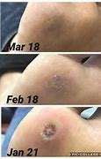 Image result for Wart Biopsy Healing Pics