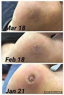 Image result for Wart Treatment Reactions