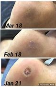 Image result for Plantar Wart Cryotherapy