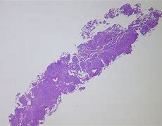Image result for Carcinoid Tumor