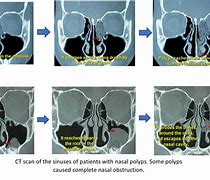 Image result for Nasal Cavity Polyps