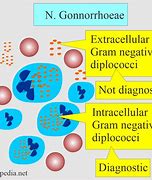 Image result for Disseminated Gonorrhea