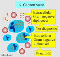 Image result for Gonorrhea Pathophysiology
