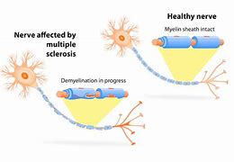 Image result for Invisible MS Disease