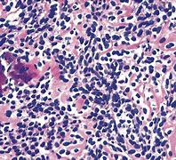 Image result for Small Cell Osteosarcoma