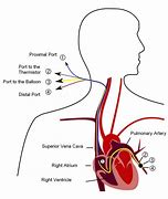 Image result for Cardiac Wedge Pressure