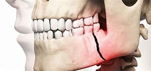 Image result for Lower Jaw Gone