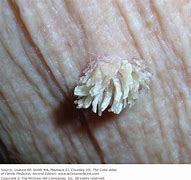 Image result for Warts On Skin Pictures