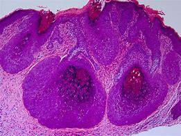 Image result for Molluscam Contagiosum Virus