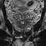 Image result for 9Mm Tumor On Prsotate