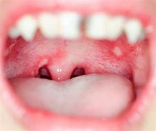 Image result for Chlamydia Mouth Sores Pictures