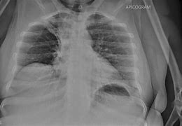 Image result for Lordotic Chest X-ray