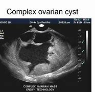 Image result for Complex Cyst