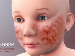 Image result for Fifth Disease in Adults Symptoms