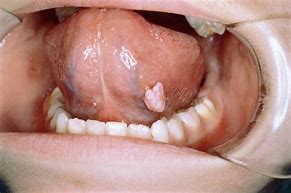 Image result for Oral HPV Tongue