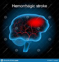 Image result for Hemorrhagic Brain Stroke