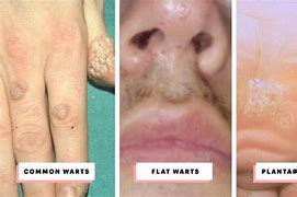 Image result for Salicylic Acid Wart Treatment