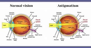 Image result for Astigmatism Contacts for Light Eyes