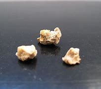 Image result for Different Kidney Stones