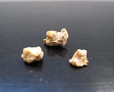 Image result for What Does a 4 mm Kidney Stone Look Like