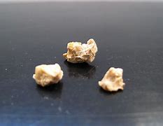 Image result for 12 mm Kidney Stone