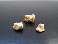 Image result for Kidney Stone Actual Size