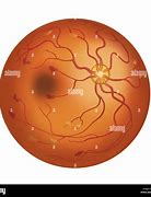 Image result for Retina Blood Vessels Eye