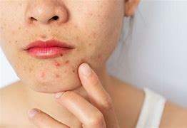 Image result for Genital Warts vs Pimple