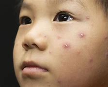 Image result for Chickenpox