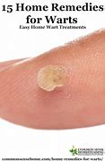 Image result for How to Treat Warts