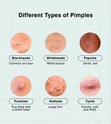 Image result for Pimples On Forehead 69