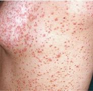 Image result for Allergic Drug Reaction Rash