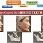 Image result for Jaw Bone Loss Periodontal Disease