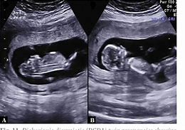 Image result for Acrania Anencephaly