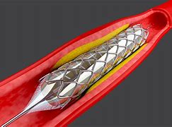 Image result for Angioplasty
