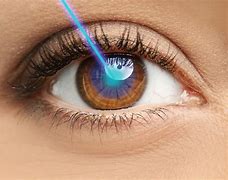 Image result for Types of Corrective Eye Surgery