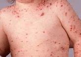 Image result for Chickenpox Dermnet