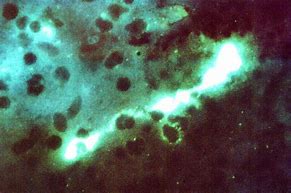 Image result for Chlamydia Bacterial Infection