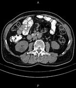 Image result for Large Renal Cyst