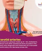 Image result for Carotid Artery in Neck Symptoms