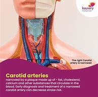 Image result for Carotid Artery Pain Left Side