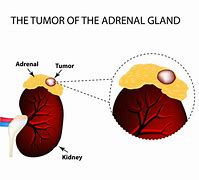 Image result for Nodule On Adrenal Gland