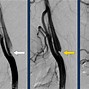 Image result for Carotid Doppler Stenosis Ultrasound Radiology