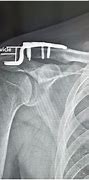 Image result for Hook Plate Shoulder