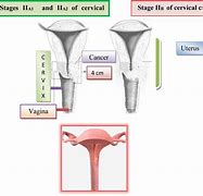 Image result for Cervical Cancer